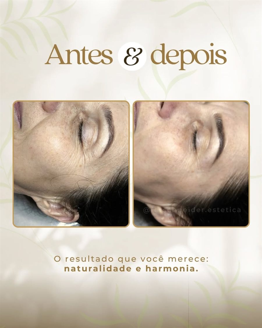 Antes e depois de uma cliente após o DermaPlus Natural, publicado pela Fernanda