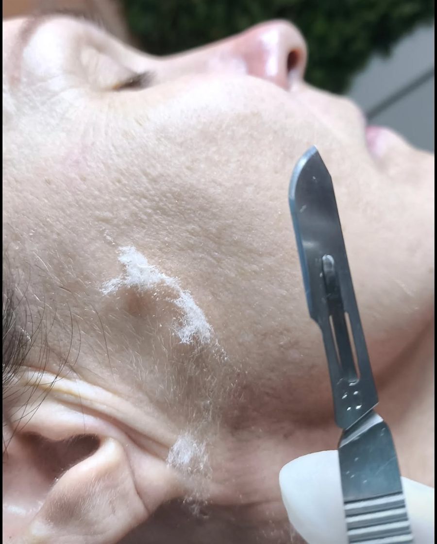 Procedimento DermaPlus Natural com raspagem suave da pele do rosto