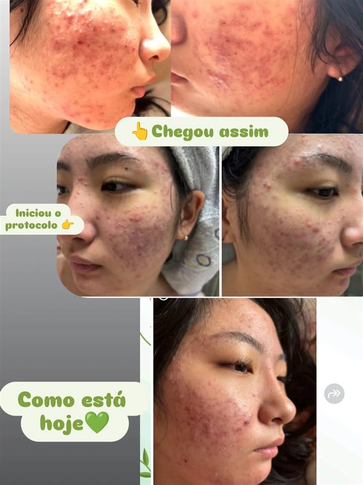 Antes e depois do tratamento de acne inflamada