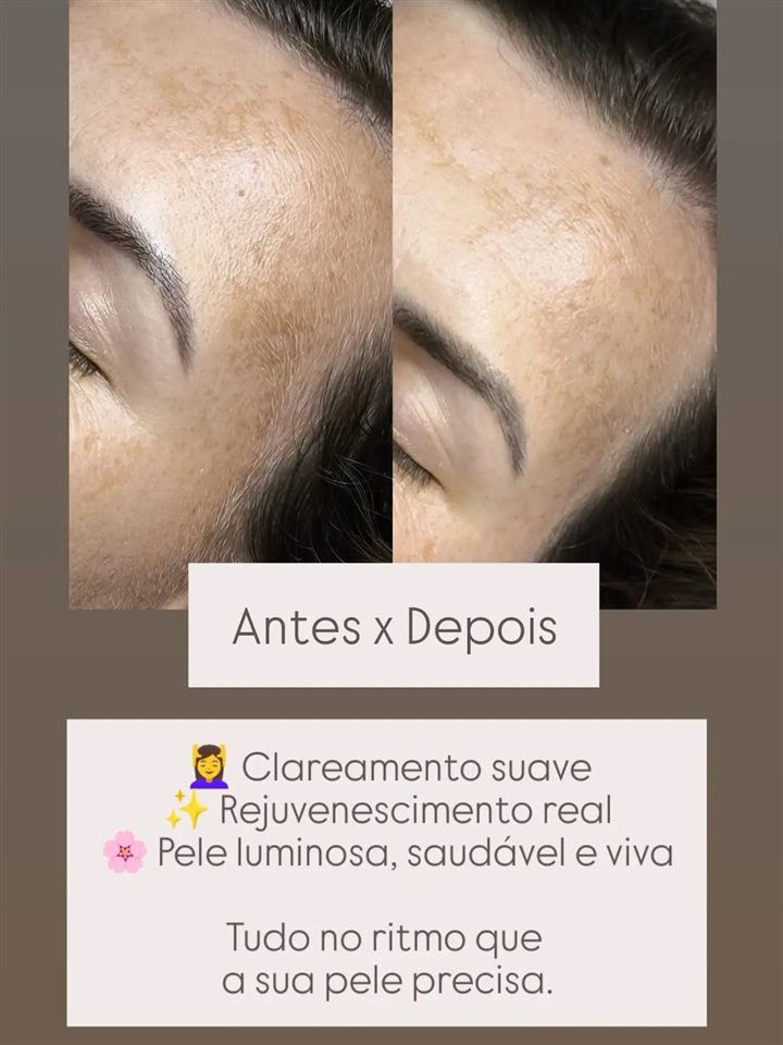 Antes e depois de clareamento e rejuvenescimento da pele